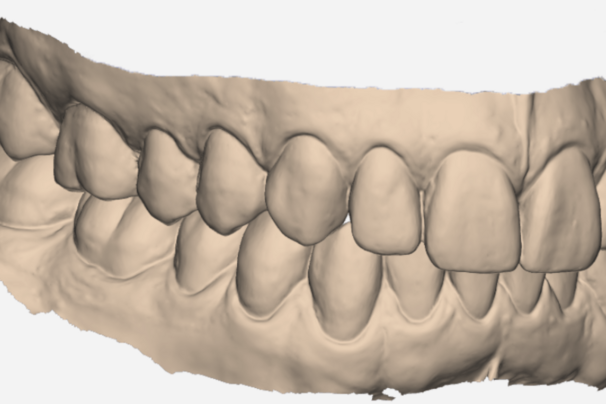 Intraoralscanner_Gebiss.png 